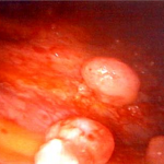 pleuramesothelioma-thoracoscopy