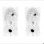 Aortitis_der_Bauchaorta