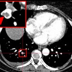 lungStudy